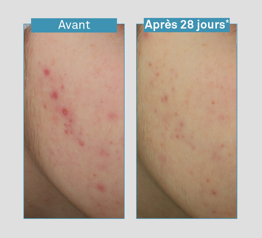 suero-antiimperfecciones