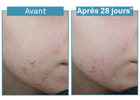 Resultados Luxéol Serum Anti-Imperfecciones